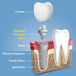 等离子体治疗植牙会产生更强的粘结